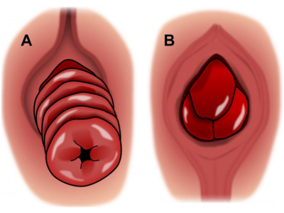 Dr Eleri Piles Clinic