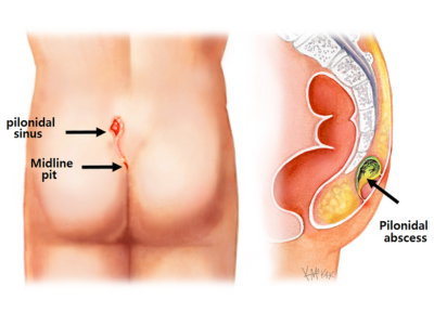 Dr Eleri Piles Clinic