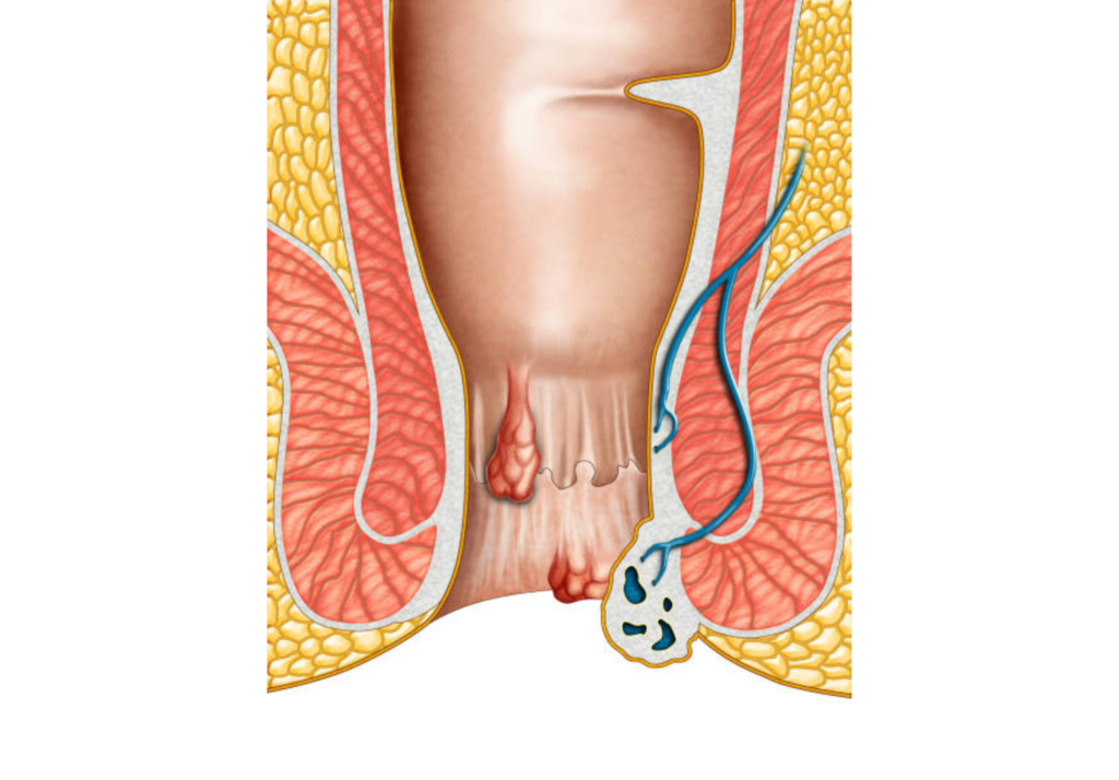 Best Piles Treatment in Miyapur Hyderabad by Dr ELERI